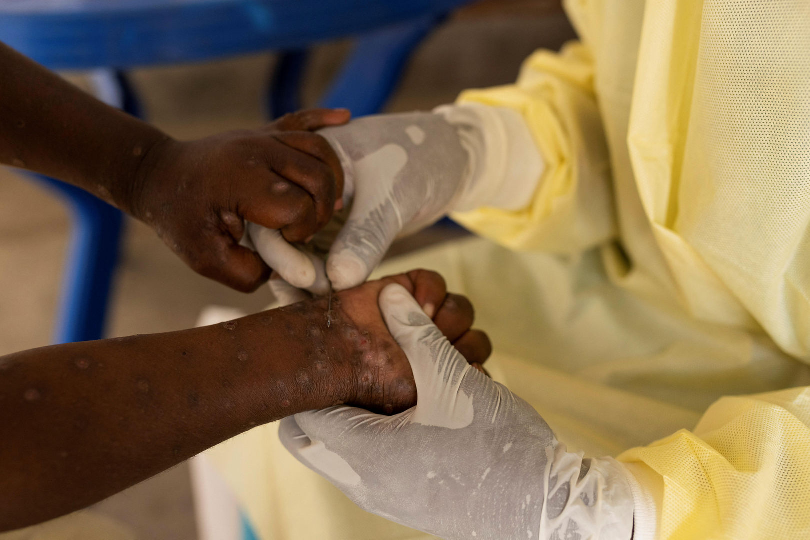 EAC Issues Mpox Alert in the Region